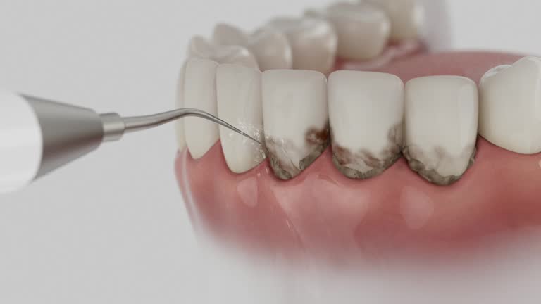 Trusted Dental Crowns And Bridges service in Prince Frederick, MD - Dentist Open Now